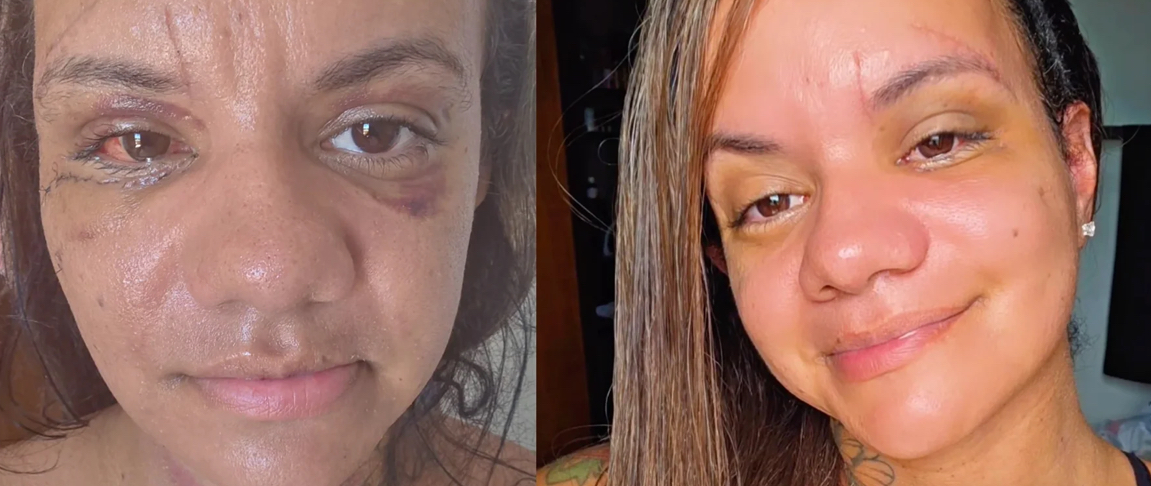 Juliana Soares, agredida com 61 socos, mostra rosto 30 dias após cirurgia de reconstrução