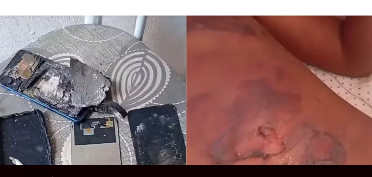 Celular pega fogo e criança de 10 anos sofre queimaduras no interior do RN