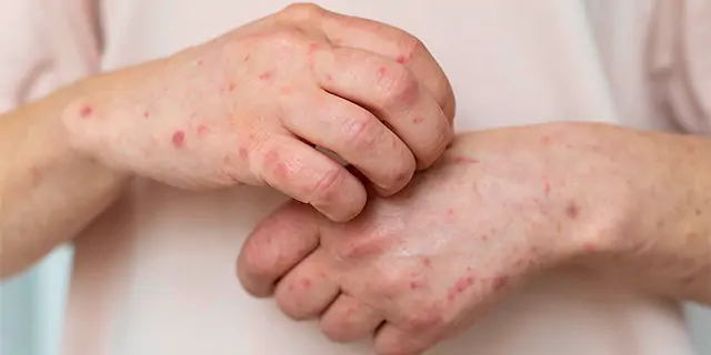 Jovem de 19 anos é isolada em UPA de Mossoró com suspeita de Monkeypox