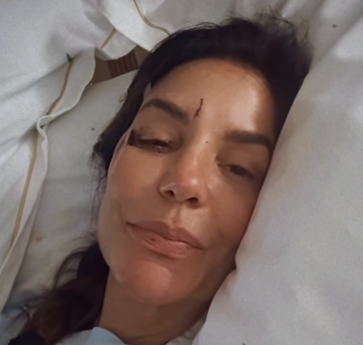 Ivete Sangalo surge em hospital com lesão no rosto após desmaio e tranquiliza fãs: “Estou bem”